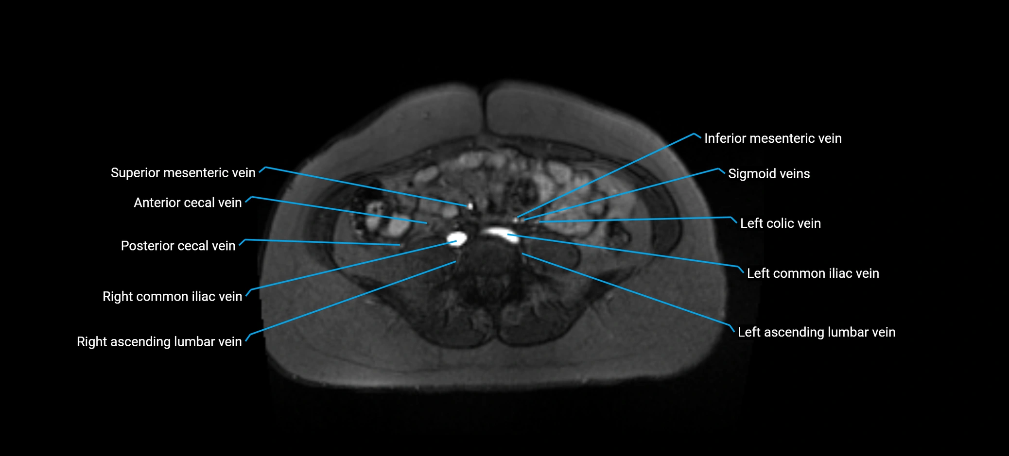 MRV abdomen pelvis & lower limb axial cross sectional anatomy labelled MRI image 120 (1).webp
